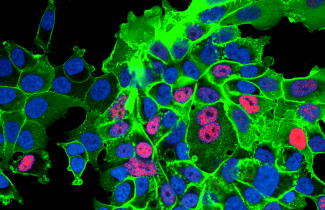 The image shows prostate cancer cells in which KLF4 and the CD44 protein on the cell membrane are stained. Image: Kirsi Kainulainen