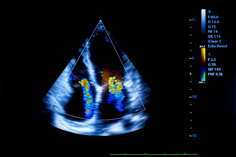 Human heart ultrasound image