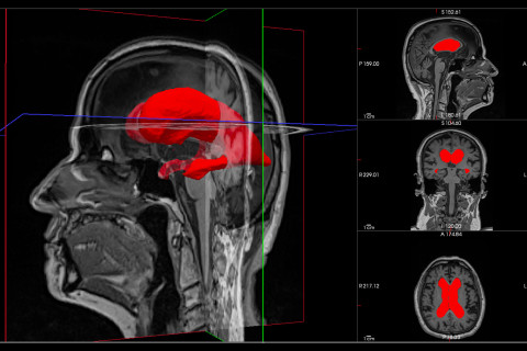 Enlarged lateral ventricles of an idiopathic normal pressure hydrocephalus patient.