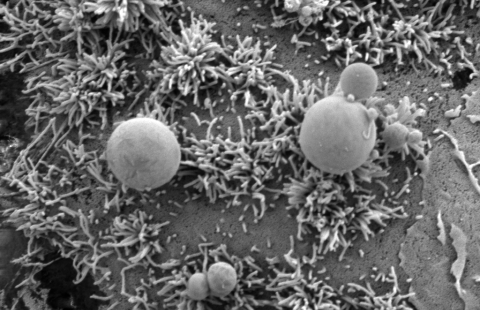 Syöpäsolun pinnalle tarttuneita vesikkeleitä pyyhkäisyelektronimikroskooppikuvassa. 