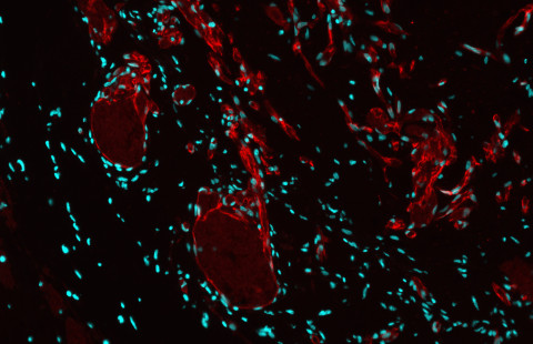 Fibroblasts participate in formation of the blood vessels in vascular malformations. 
